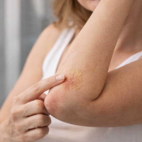 Tallow honingzalf ruwe elleboog droge huid vrouw bio-identiek rauwe honing healing balm natuurlijke verzorging eczeem